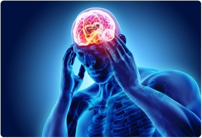 treat migraine